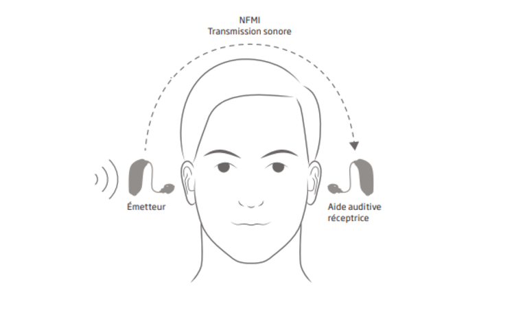 Actualité audioprothésiste audio : Appareillage auditif Cros BiCros